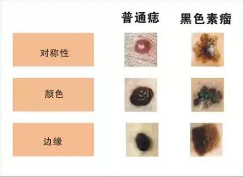 凸痣長毛|痣變大、痣多或長毛會變皮膚癌？認識痣的形成與原因